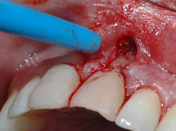 Киста зуба: не упустите первые симптомы!